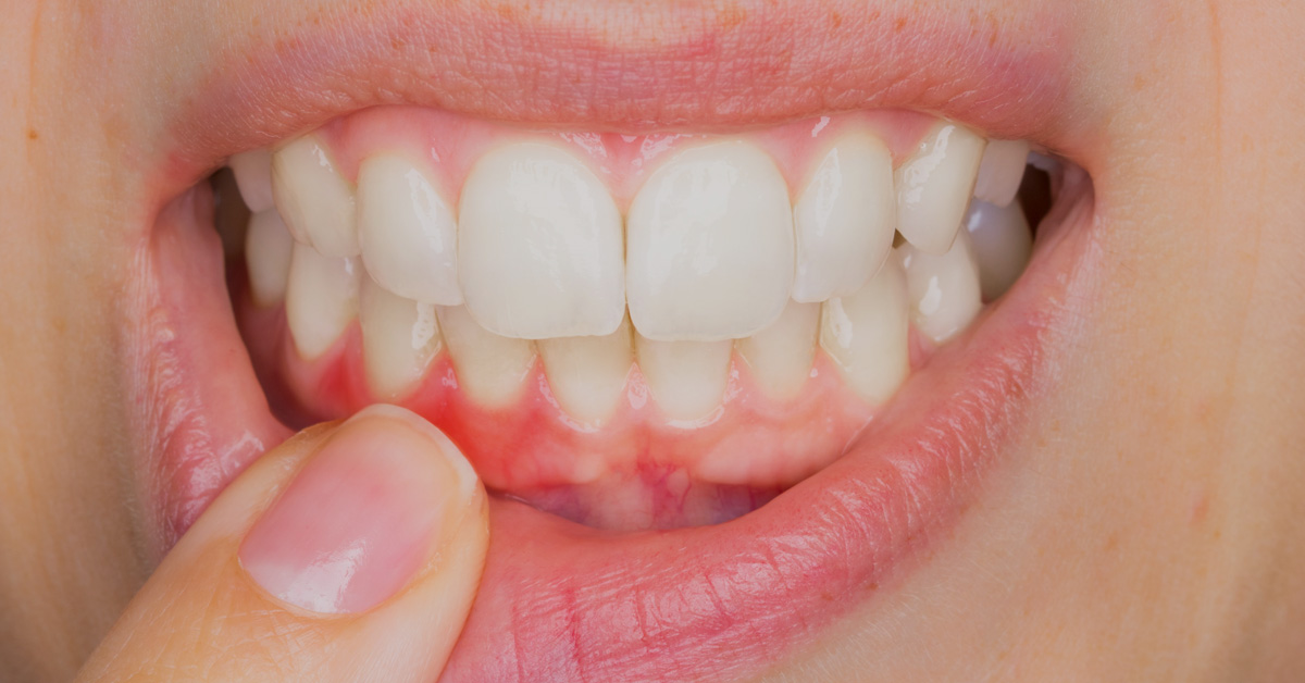 Embarazo Y Gingivitis